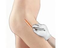 Minimally Invasive Hip Replacement